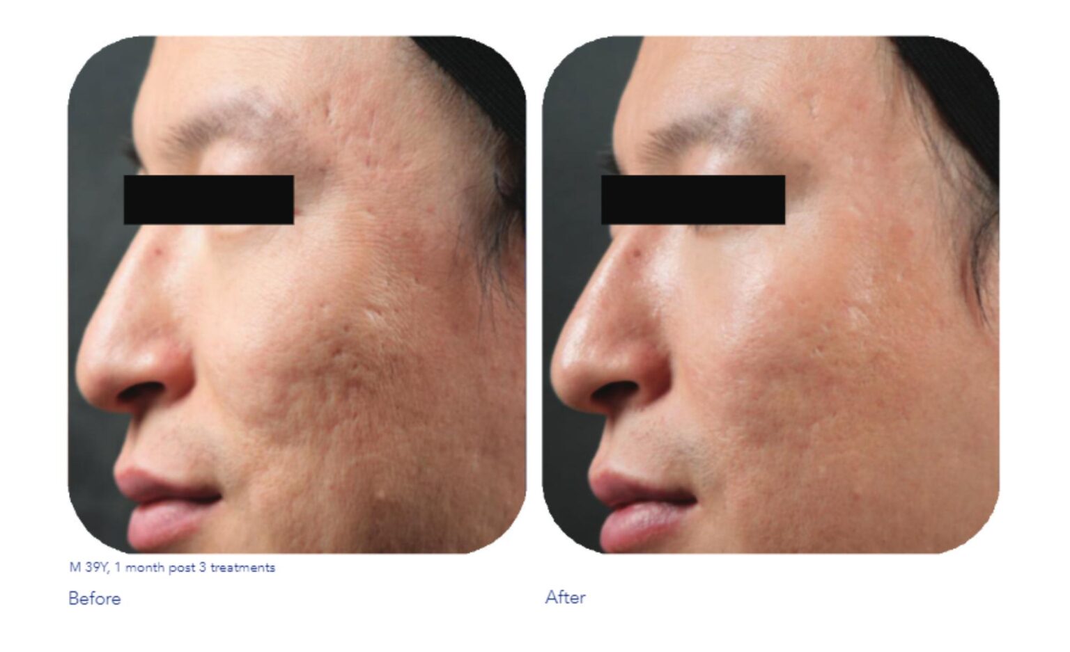 Scar Therapy Dr Chernoff Plastic Surgery