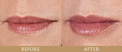 My Juvederm Under Eye Filler Before After Will Blow You Away - h8plpxq