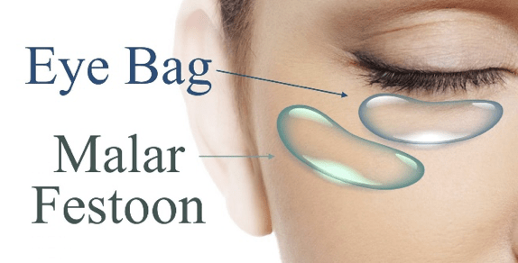 Eye-Bags-And-Malar