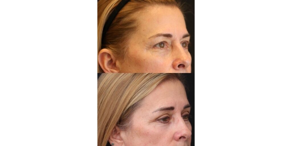 Eyelid Lift Surgery: The Tried-and-True Way to Take Years off Your Face