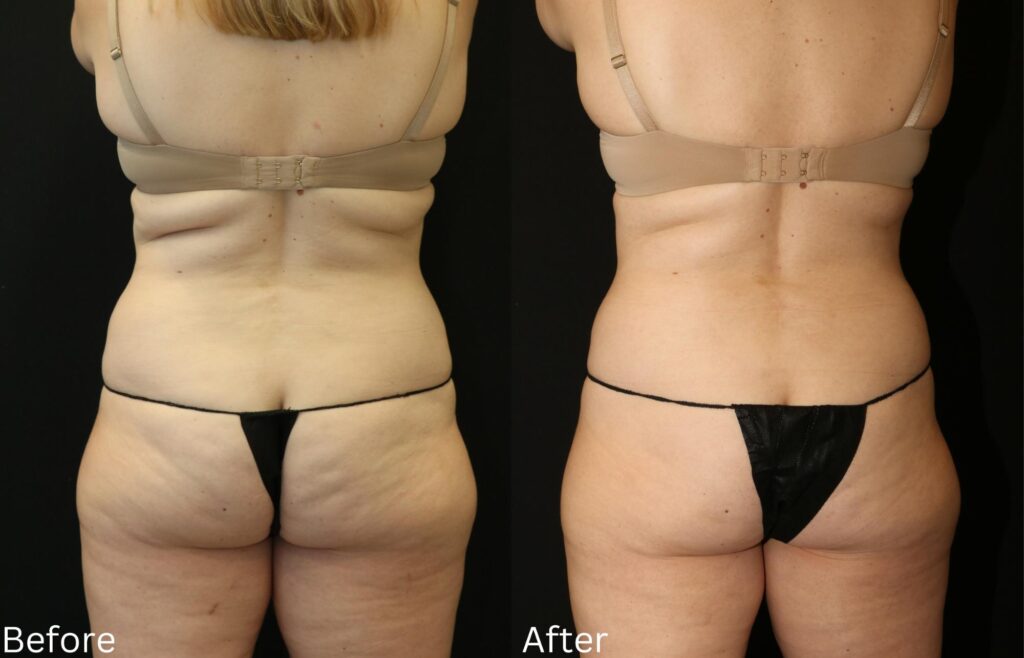 CoolSculpting2