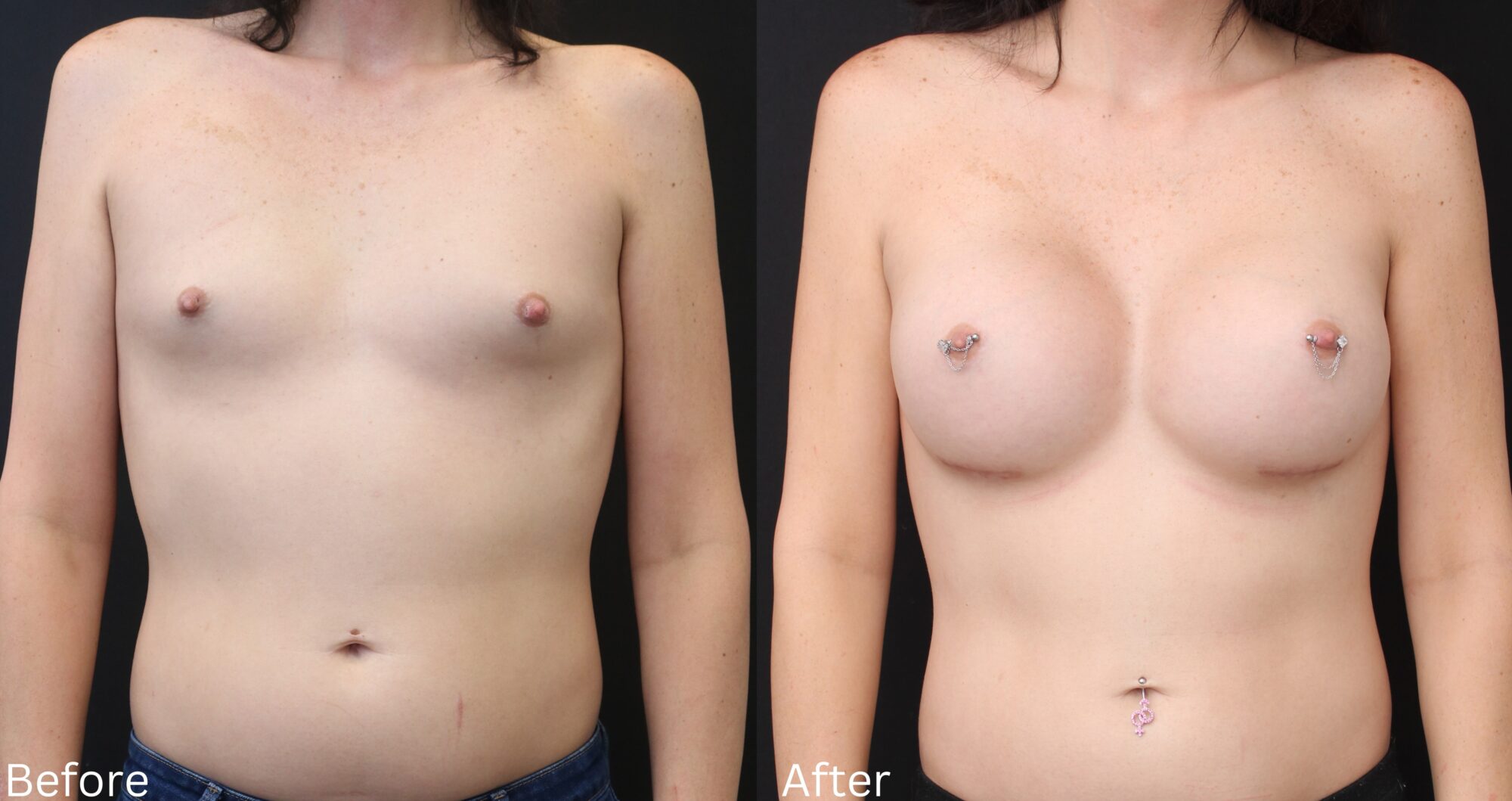 Male to Female breast augmentation