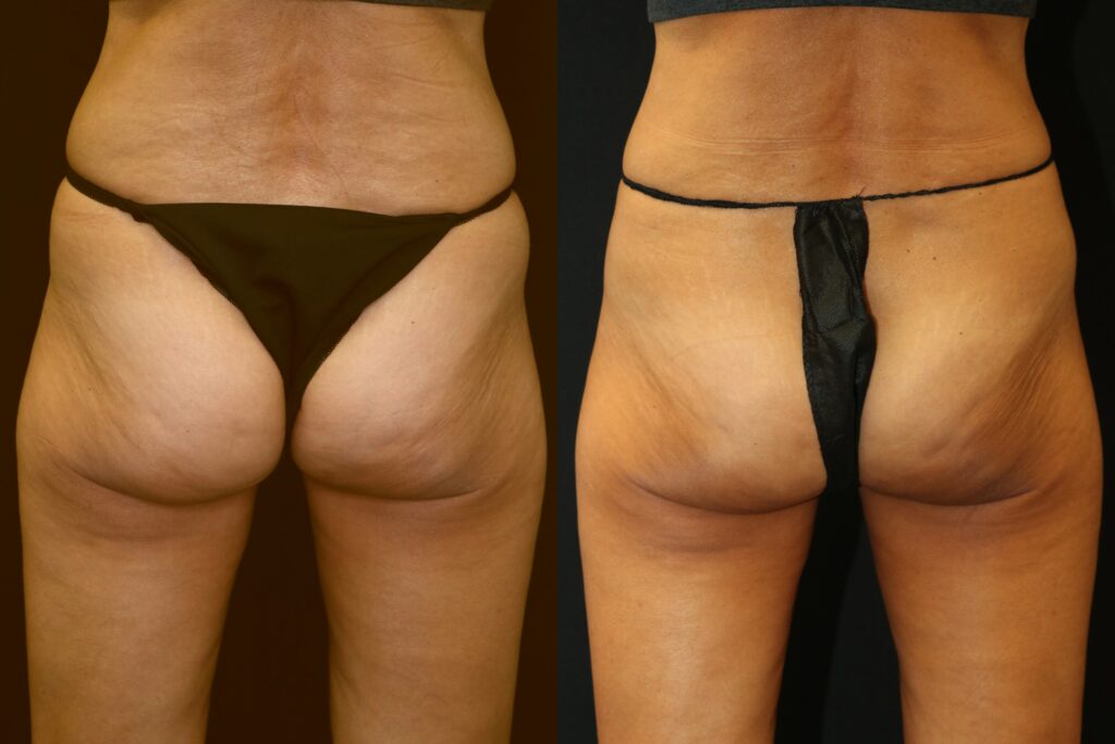 CoolSculpting7B