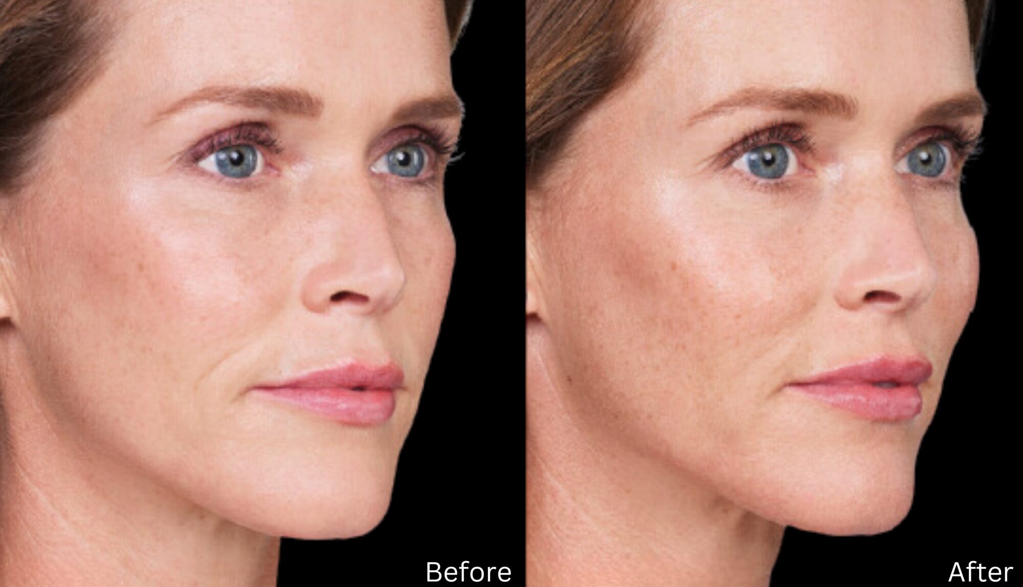 Volbella - Dr. Chernoff Plastic Surgery