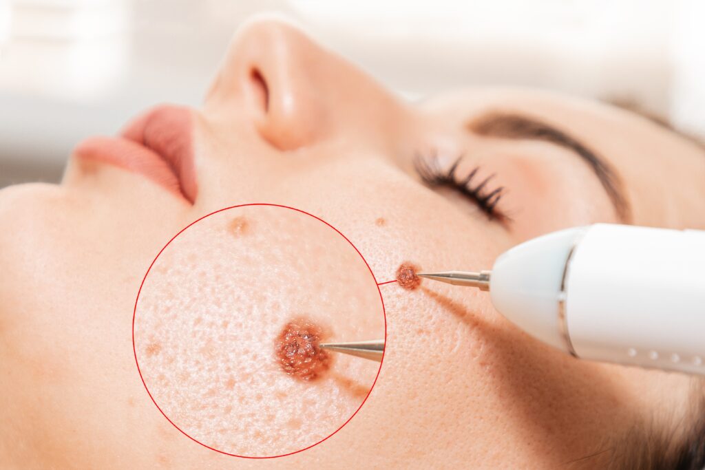 Mole removal at Chernoff Cosmetic Surgery in Indianapolis