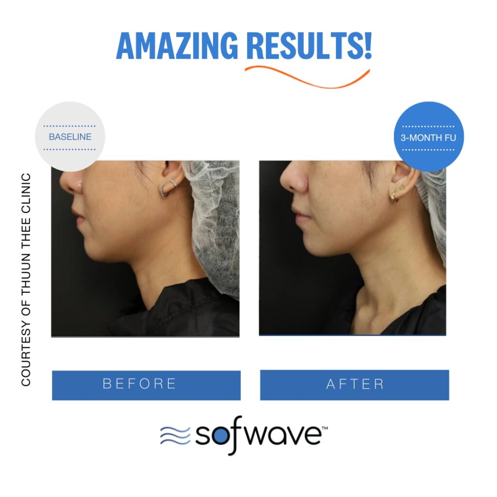 Sofwave