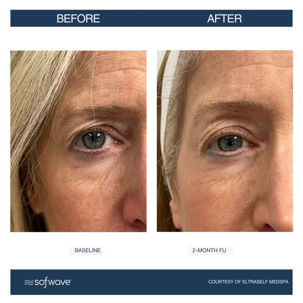 Set-58-Eyebrow