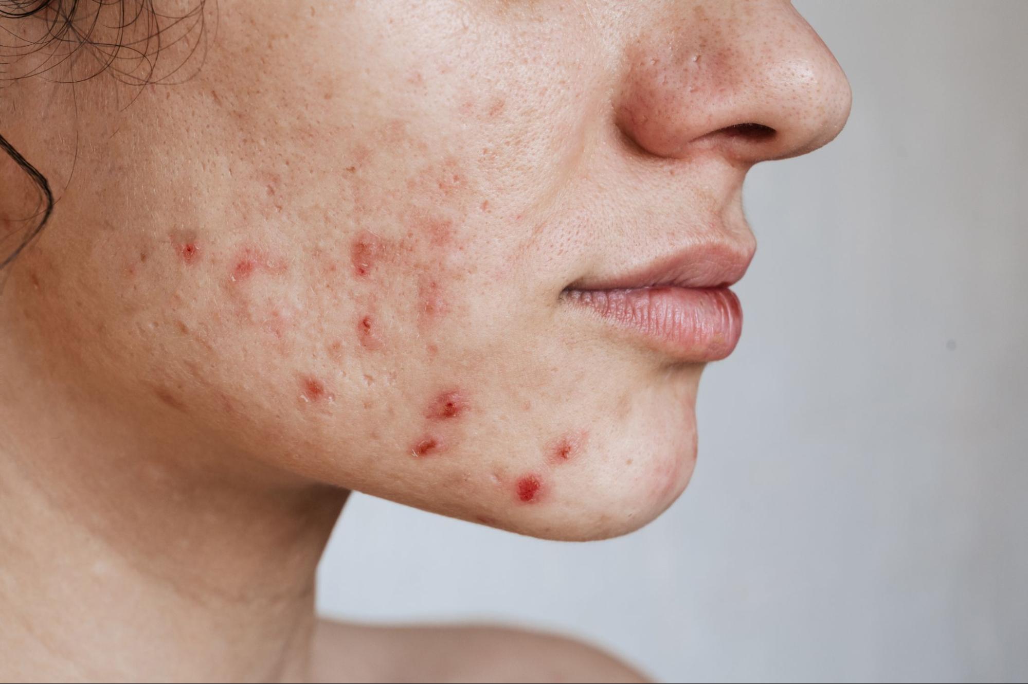 5 Ways to Improve Winter Acne in Indianapolis