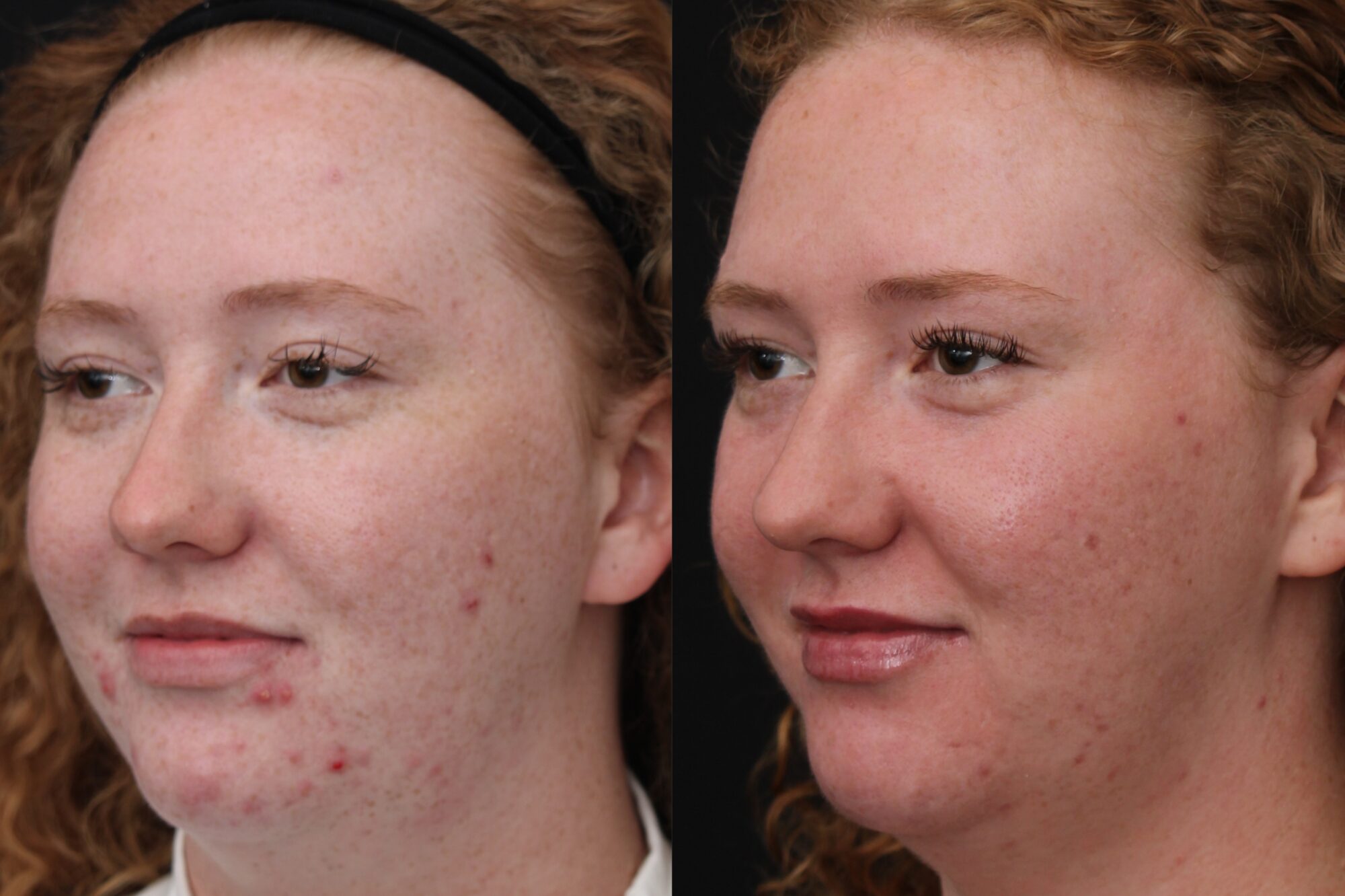 Face Reality Before and Afters - 8