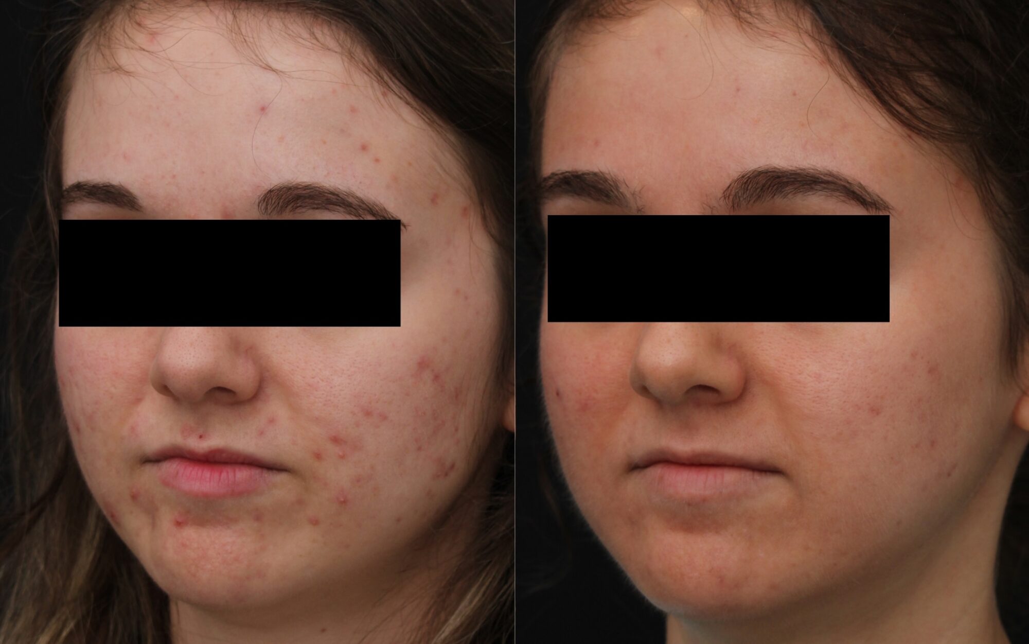 patient relaxing during non-surgical Indianapolis wrinkle treatment