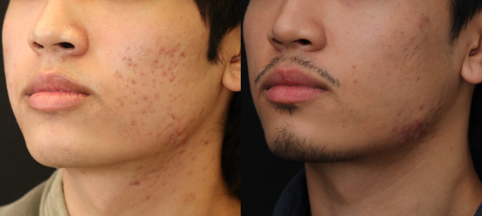 Before and after images of a male patient showcasing significant improvement in acne treatment results from Dr. Chernoff's Acne Bootcamp, highlighting skin texture and clarity.