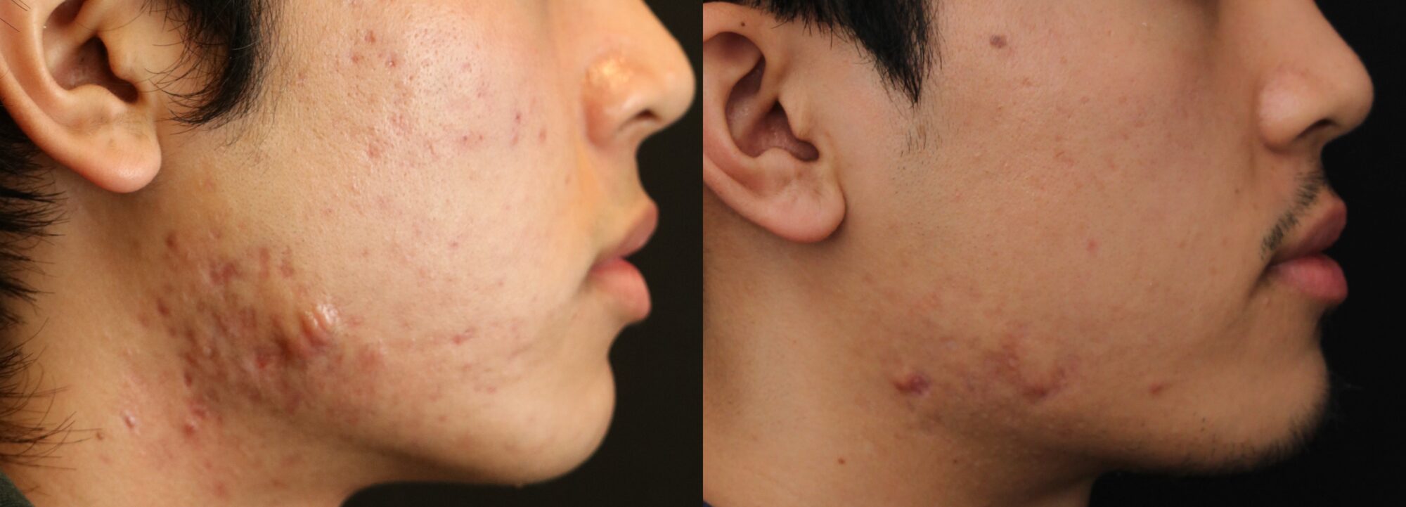Before and after image showcasing acne treatment results from Dr. Chernoff's Acne Bootcamp, highlighting improvement in skin texture and clarity, relevant to plastic surgery consultation in Indianapolis.