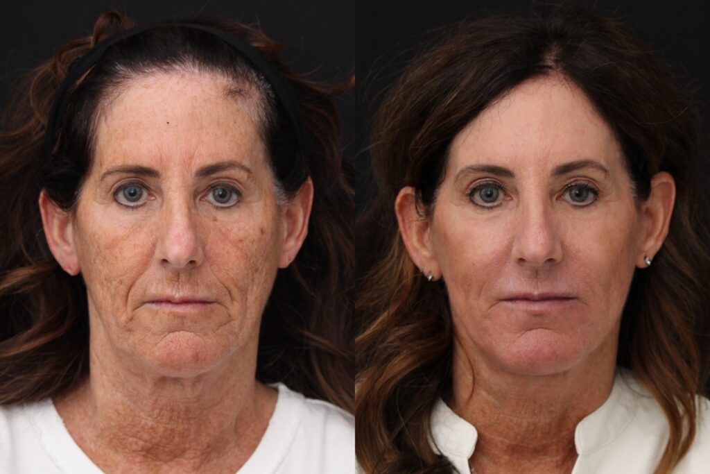 clinician marking treatment areas prior to Indianapolis body sculpting