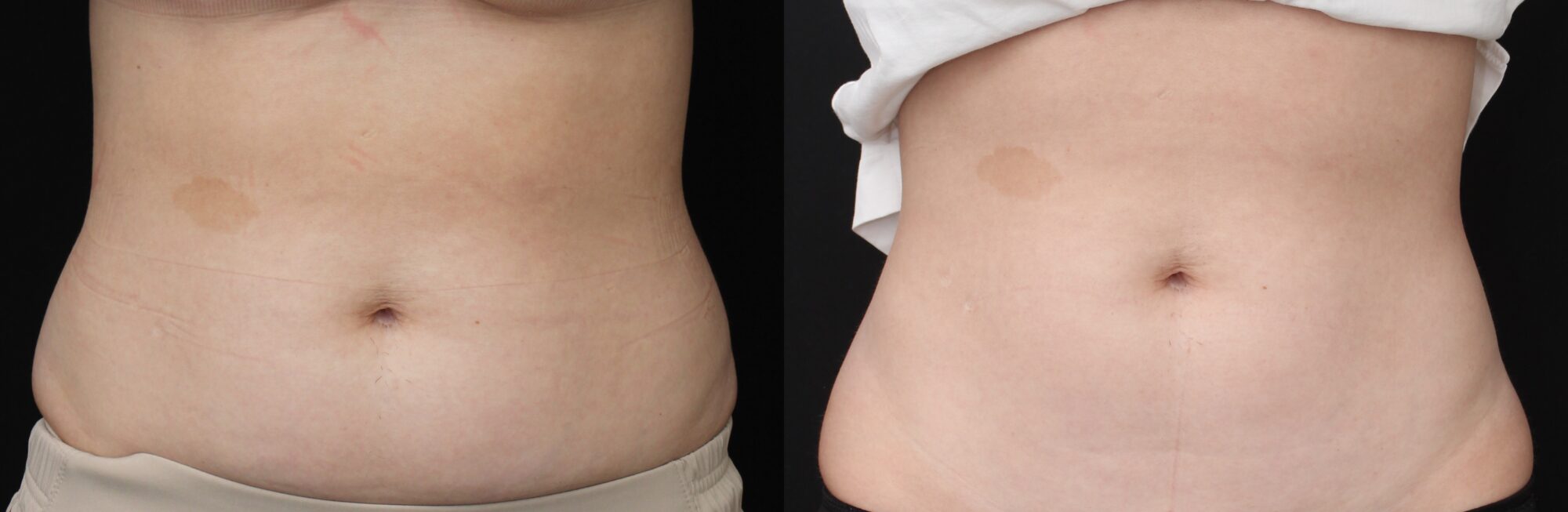 before and after torso photos following body sculpting in Indianapolis
