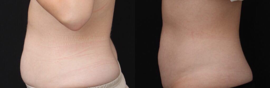 patient consultation for body sculpting Indianapolis in modern clinic