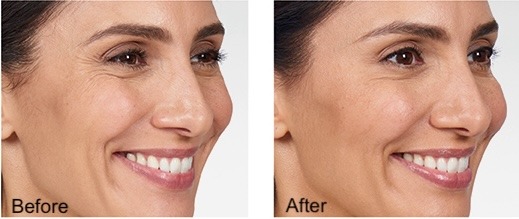 Before and after of Botox treatment from a plastic surgeon in Indianapolis.