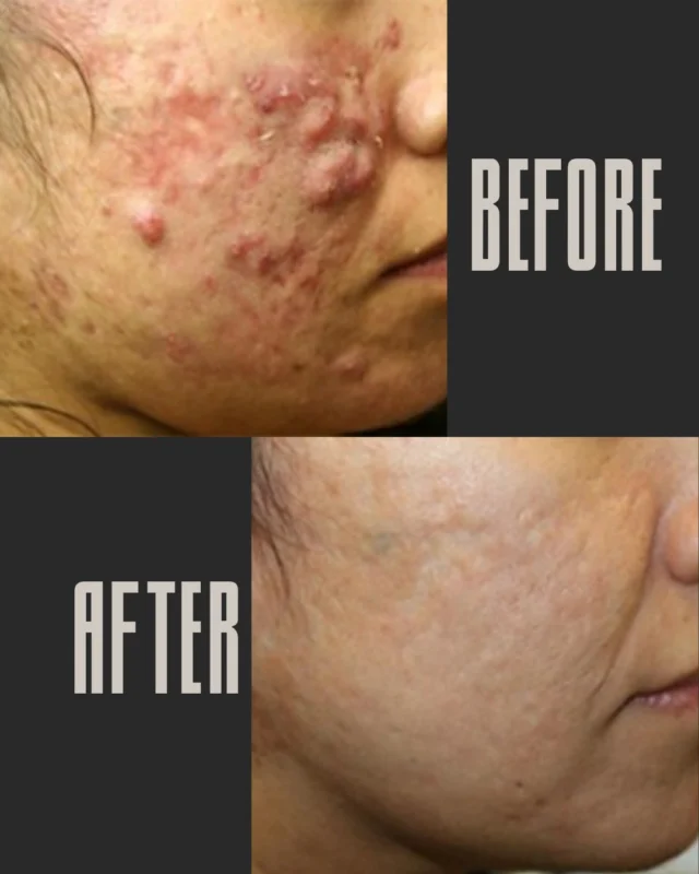 Clear skin starts here ✨ Check out these amazing before and after results with Aerolase laser treatment for acne! This gentle, no-downtime laser targets acne-causing bacteria, inflammation, and redness to reveal smoother, healthier skin. Ready to transform your skin? Schedule your consultation today at @chernoffcosmeticsurgery  with our acne expert @jennifermiller_aesthetician!