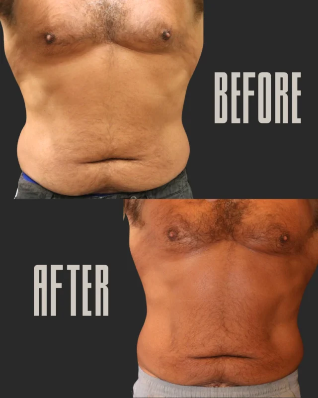 Bye, stubborn belly fat. Hello, confidence. 👋🔥 Offers available!

This CoolSculpting transformation proves that non-surgical fat reduction works. No surgery. No downtime. Just results.

Ready to sculpt your best body yet? 💪 Now until May 31st, Buy 4 CoolSculpting cycles get 4 Free!